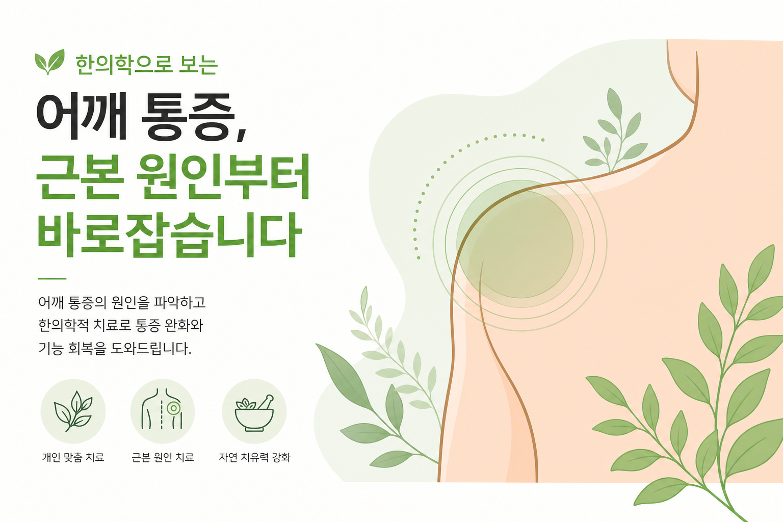 어깨 관절 해부도 — 회전근개 4개 힘줄(극상근, 극하근, 소원근, 견갑하근) 위치를 표시한 인포그래픽. 건염과 파열 부위를 색으로 구분. 회전근개 PDRN 주사 이미지