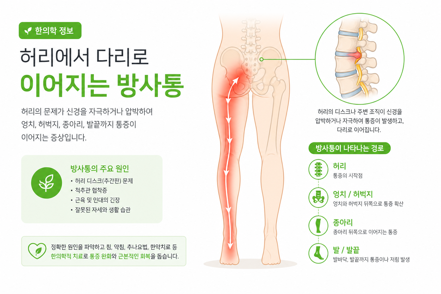 허리에서 다리로 이어지는 방사통 경로를 화살표로 표시한 인체 인포그래픽 이미지 운전 허리 통증 이미지